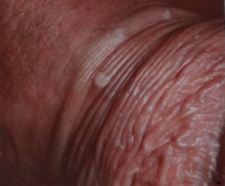 Lesioni maculari del pene evidenziate alla peniscopia in paziente con HPV DNA positivo per HPV ad alto rischio (Archivio fotografico del Dott.Giuseppe Scaglione )
