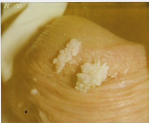 Condilomi floridi - pin 2-3 del pene (Archivio fotografico del Dott. Giuseppe Scaglione )